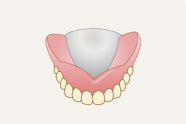 金属床義歯のイメージ