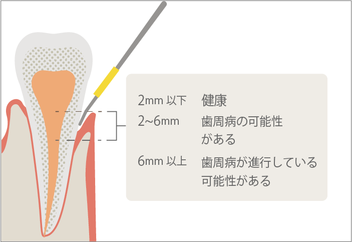 歯周ポケット検査イメージ