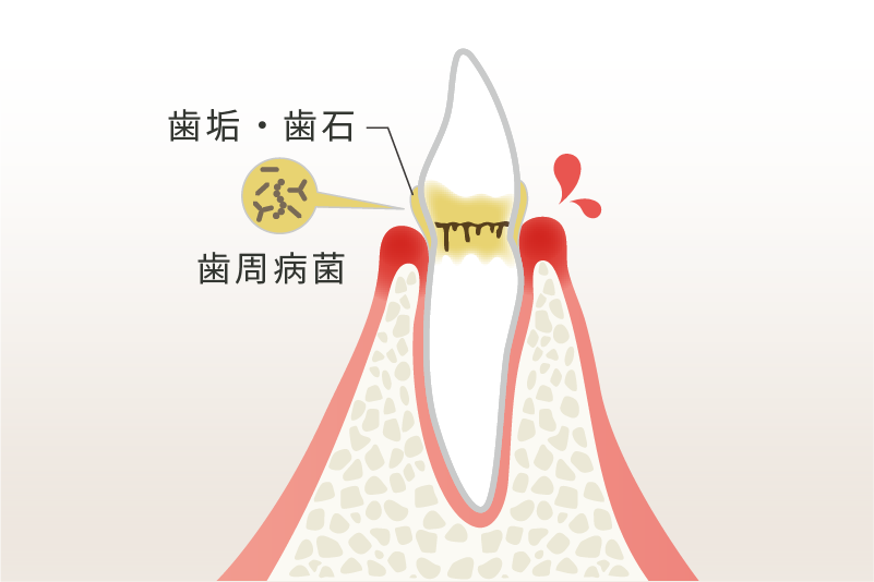 歯肉炎・軽度歯周病のイメージ