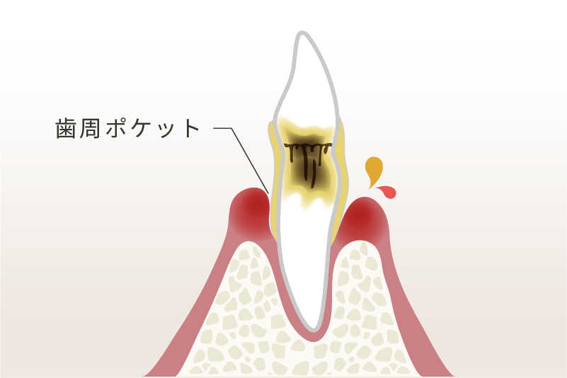 中等度歯周病のイメージ