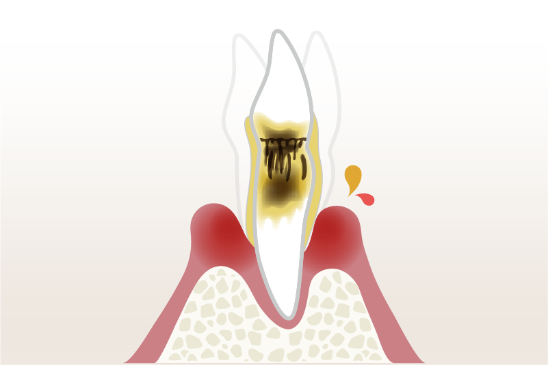 重度歯周病のイメージ