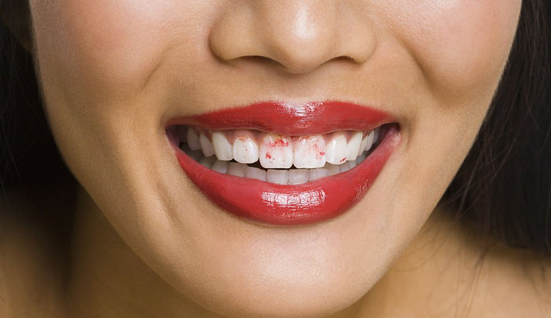 歯紅の原因と対策